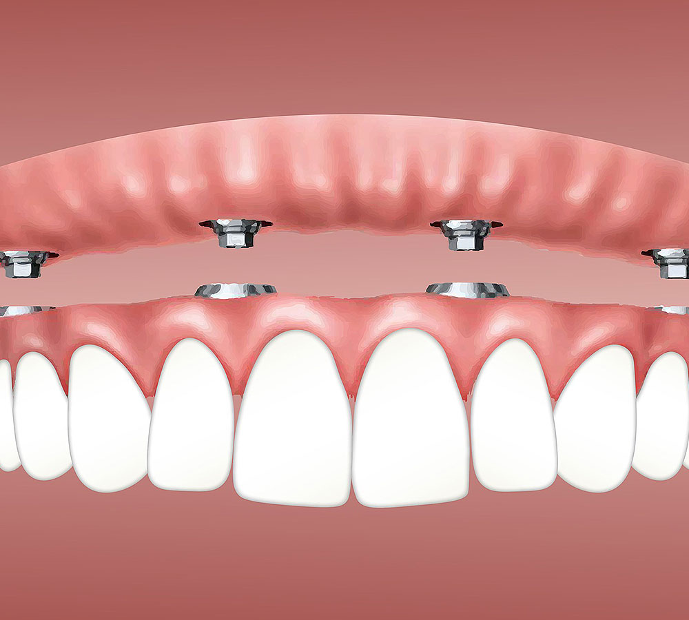 Benefits of Dental Implants Dental Centre Westmount