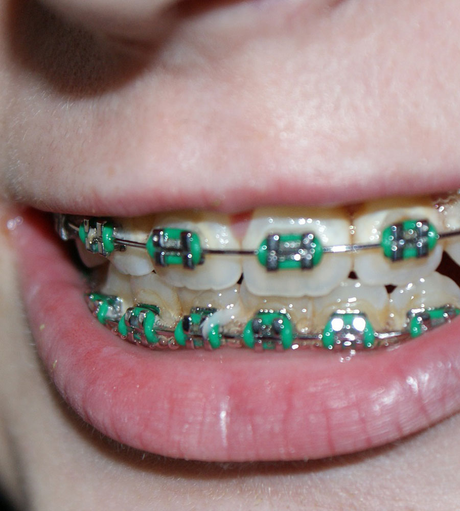 How to Keep Teeth Straight After Braces Retter Westmount dental clinic