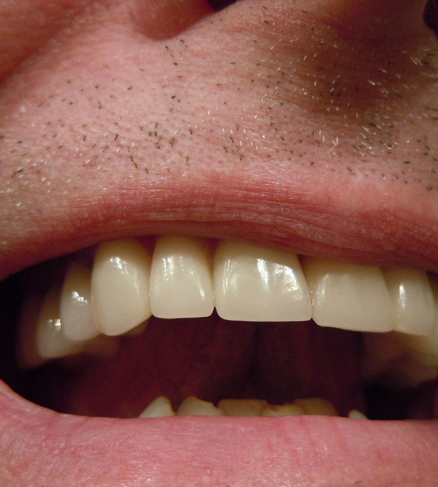 What To Do When a Crown Falls off Your Tooth? Dental Clinic Montreal